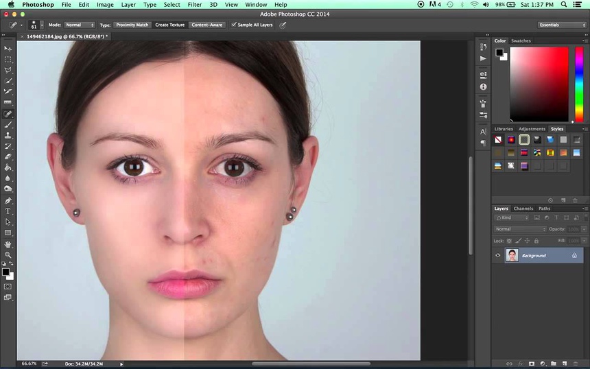 Xóa mụn thừa trên da mặt