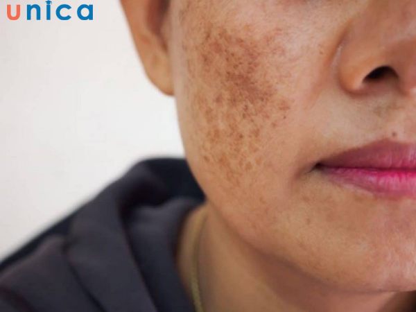 Rối loạn nội tiết tố gây ra nám