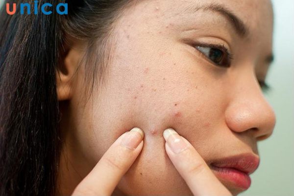 Không nên tự ý nặn mụn ở nhà