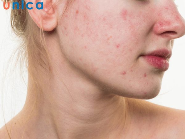 Đặc điểm của làn da mụn