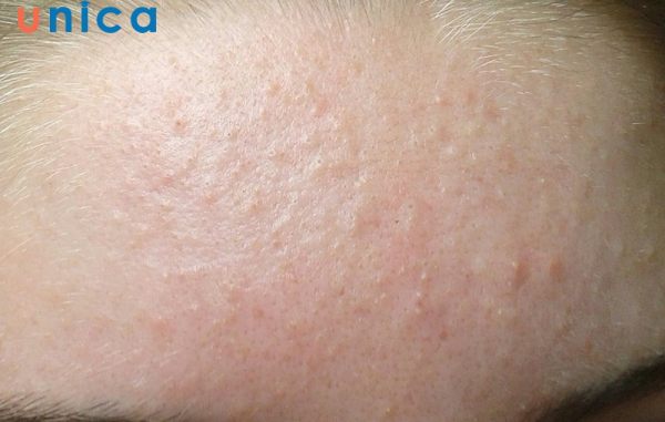 Dấu hiệu nhận biết mụn ẩn bao gồm bề mặt da gồ ghề
