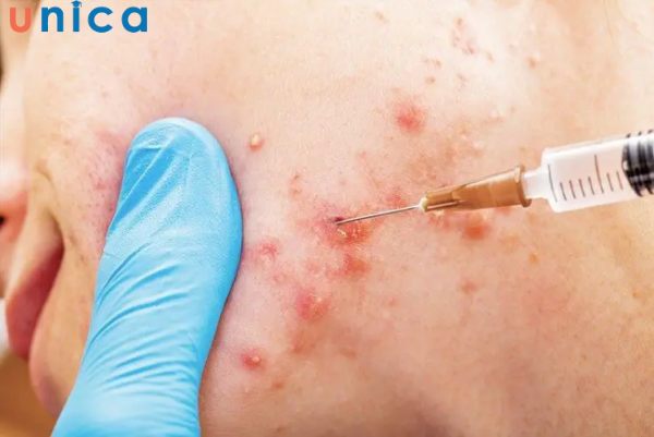 Tiêm cortisone