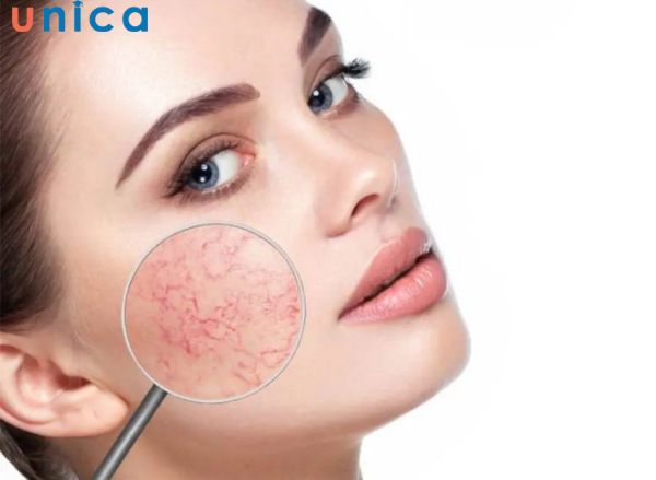 Da mặt mỏng dễ bị kích ứng