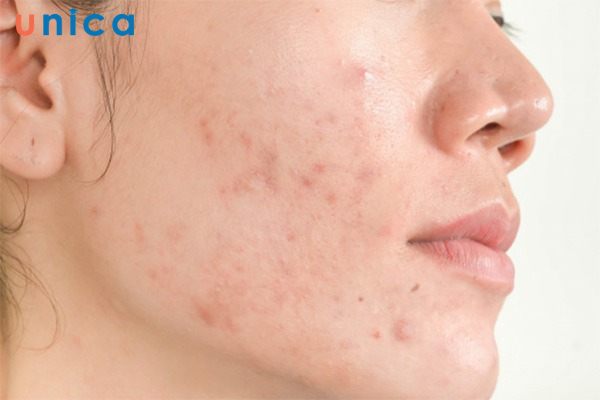 Dị ứng da do đắp mặt nạ khoai tây và sữa tươi không đường tới từ nguyên nhân chính là dùng khoai tây hỏng