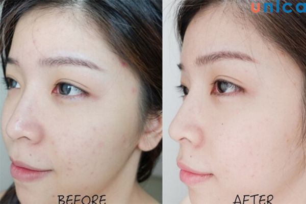 Kem trị mụn Laser có dùng được cho bà bầu không?