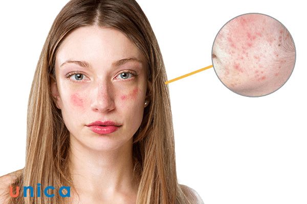 Kem dưỡng cho da nhạy cảm không được chứa các hợp chất như paraben, cồn, các chất tạo mùi hoặc gây kích ứng da