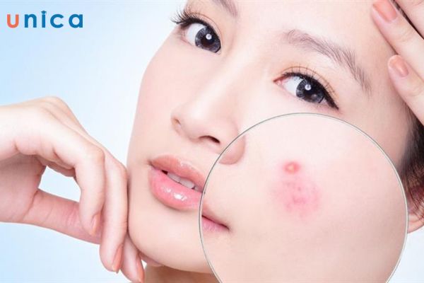 Mặt nạ trà xanh sữa tươi có tác dụng trị mụn hiệu quả