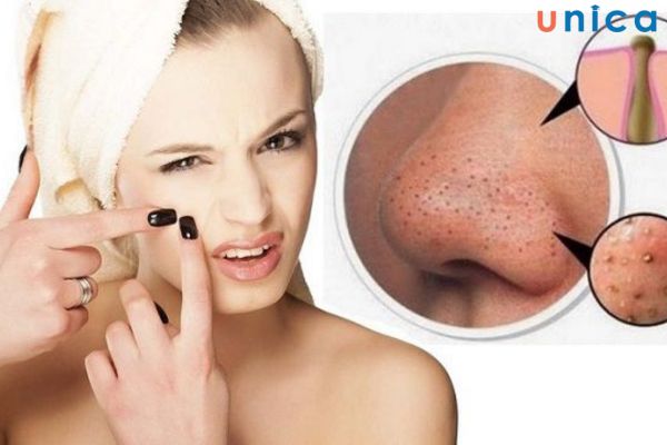 Sử dụng quá nhiều chất kích thích là nguyên nhân điển hình gây mụn đầu đen