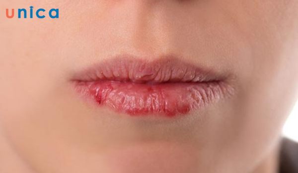 Môi bị kích ứng do dùng son chứa nhiều chì