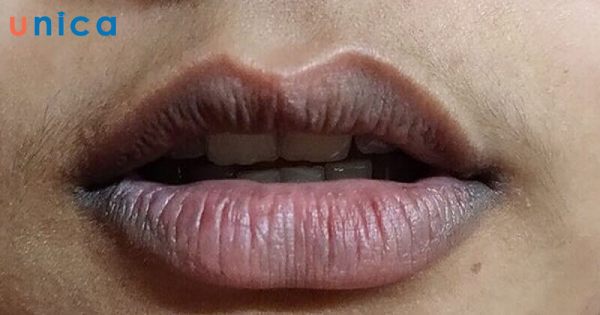 Môi bị thâm đen do dùng son chứa nhiều chì