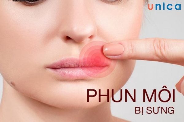 Cần đi gặp bác sĩ ngay khi thấy môi sưng kèm biểu hiện bất thường