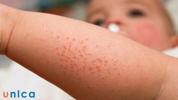 Có nhiều nguyên nhân dẫn tới rôm sảy ở trẻ em