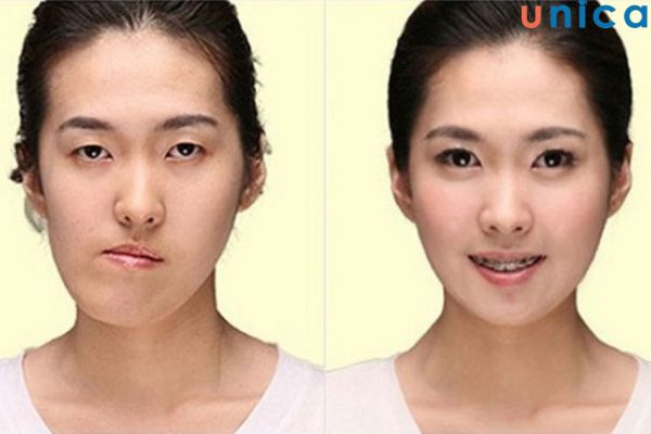 Mặt lệch do gặp các vấn đề về răng