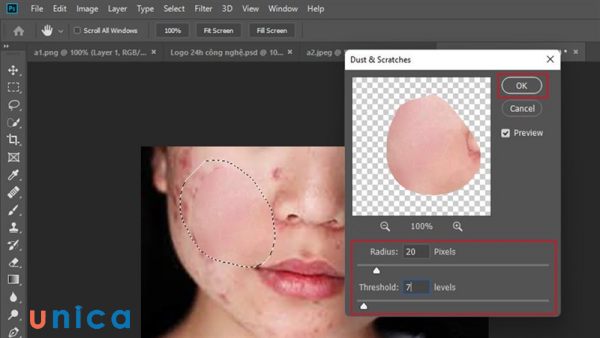 Điều chỉnh giá trị của Radius và Threshold sao cho vùng mụn bị mờ đi nhưng vẫn giữ được chi tiết của da