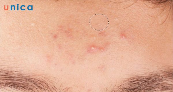 Kết quả xóa mụn bằng Dust & Scratches noise