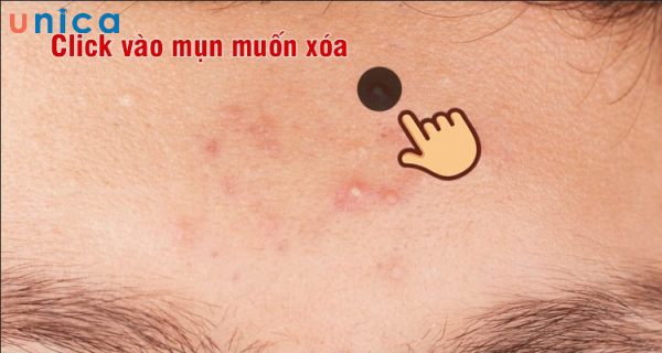 Chọn vùng da cần xóa mụn