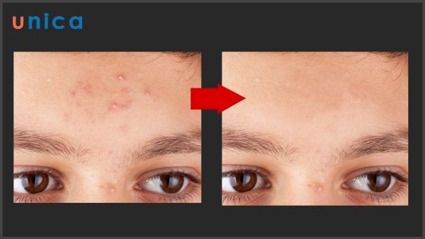 Kết quả xóa mụn