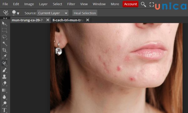 Lấy vùng da không mụn lắp vào các vùng có mụn