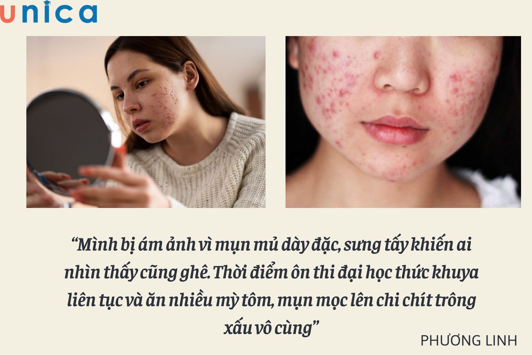 Nỗi ám ảnh da mụn