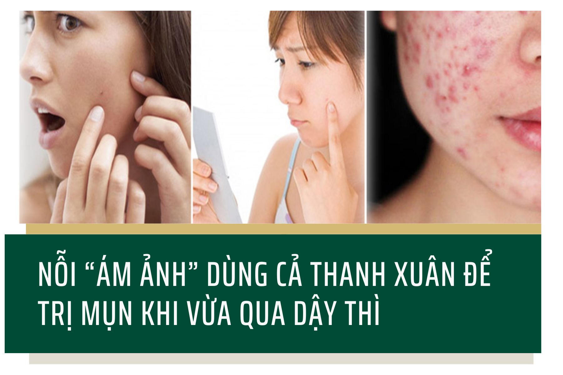 Nỗi ám ảnh dùng cả thanh xuân để trị mụn khi vừa qua dậy thì