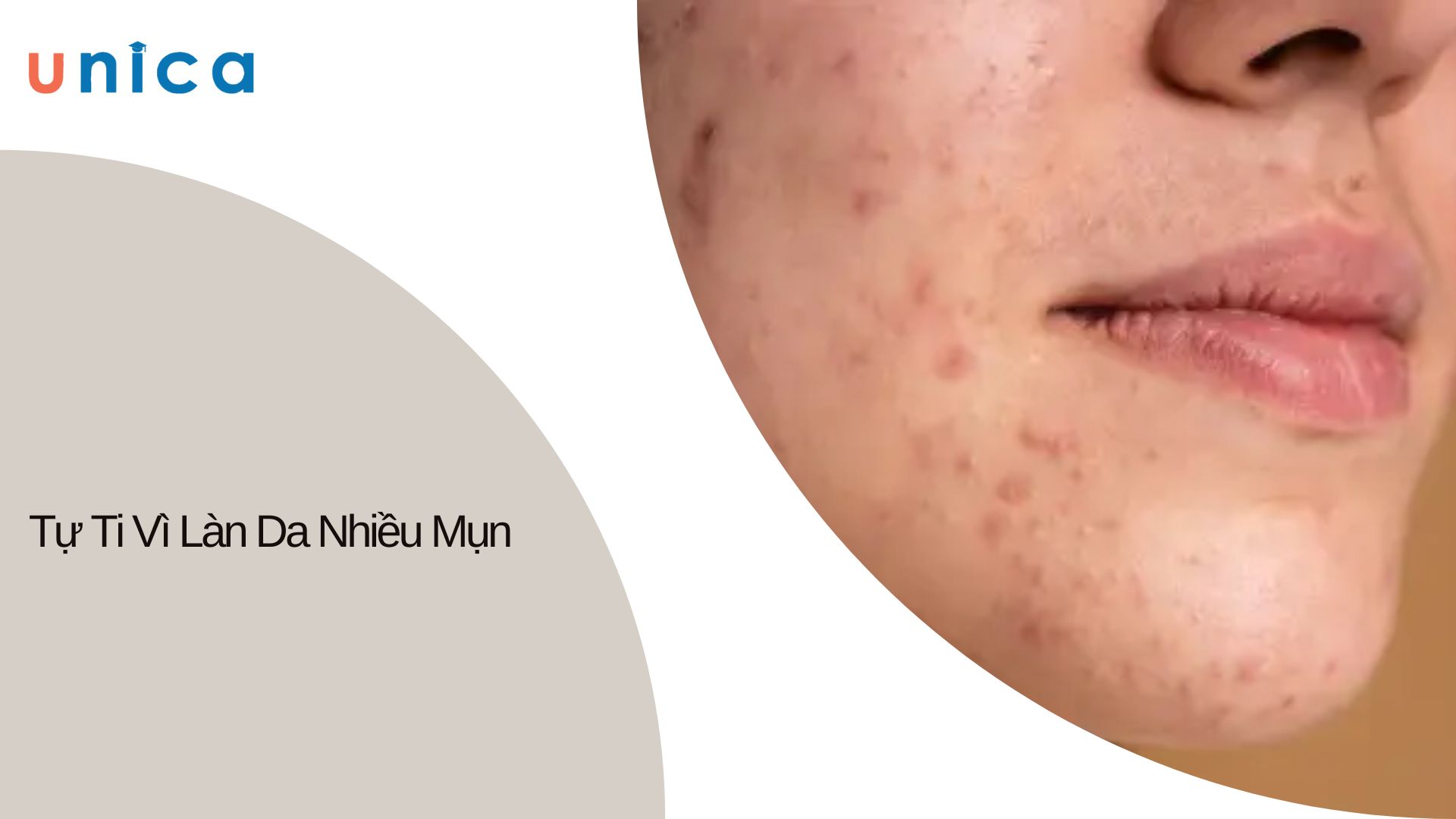 Tự tu vì da mặt nhiều mụn