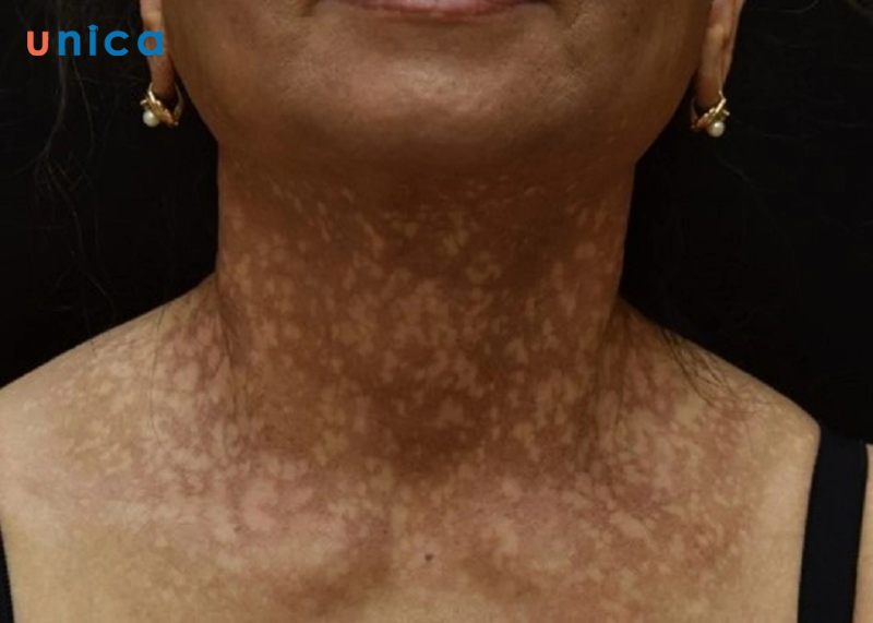 Căng thẳng là một trạng thái tâm lý không tốt khiến lượng độc tố trong cơ thể tăng lên