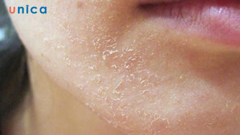 Không dùng tay cạy lớp vảy trên mặt