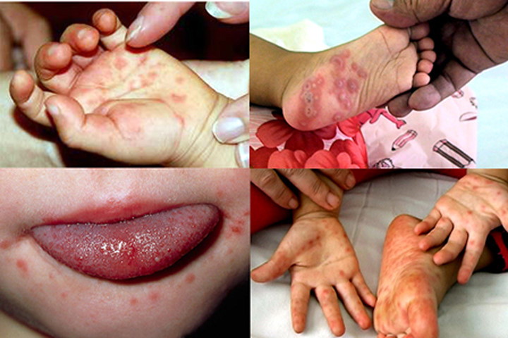 Trẻ bị tay chân miệng bôi thuốc gì? 8 loại thuốc an toàn cho bé